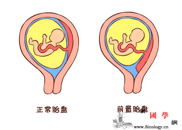 讲一讲孕期常见的“见红”原因及应对措施_胎盘-孕期-妊娠-阴道-