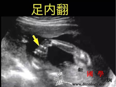 胎儿足内翻四维图_则是-脚掌-超声-胎儿-