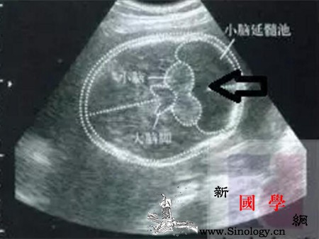 胎儿后颅窝池正常值后颅窝池增宽会怎样_延髓-正常值-染色体-胎儿-