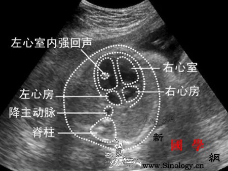胎儿左心室强光点的原因大部分孕后期可自行消_染色体-回声-胎儿-光点-