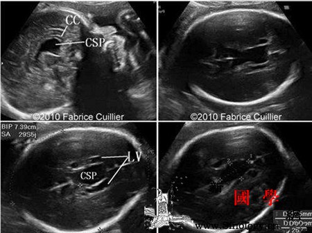 胎儿第三脑室正常值是多少_脑室-脑积水-脑脊液-正常值-