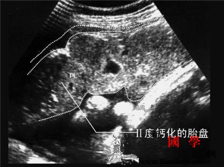 胎盘钙化是什么原因造成的有什么影响_足月-钙化-胎盘-宫内-