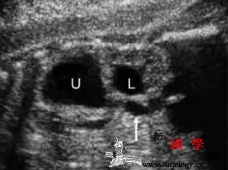 胎儿重复肾超声表现_肾盂-输尿管-羊水-肾脏-