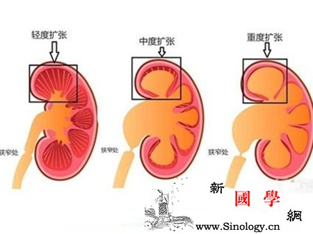胎儿肾积水是什么原因造成的_梗阻-尿液-尿道-膀胱-