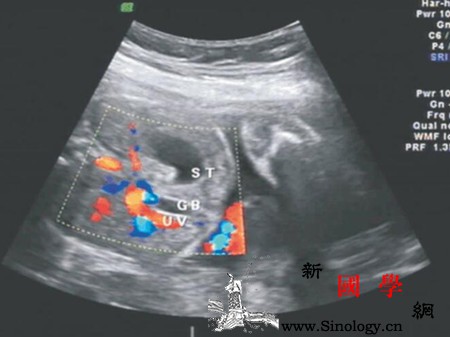 胎儿永久性右脐静脉是什么意思_导管-胆囊-回流-永久性-