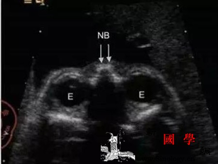 胎儿鼻骨正常值胎儿鼻骨怎么检查_正常值-回声-超声-胎儿-