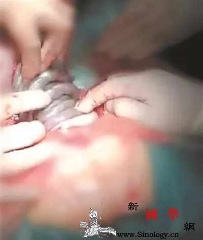 4个孕妇就有1个遇到过脐带问题需要赶紧剖出_脐带-胎儿-缠绕-足月-