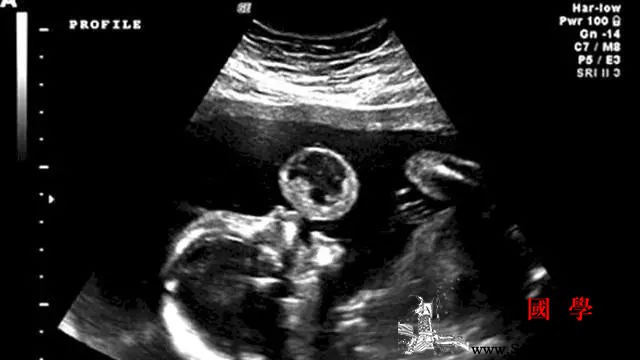 孕妈B超产检看到宝宝在吹泡泡这是怎么回事？_胚胎-孕期-胎儿-超产-