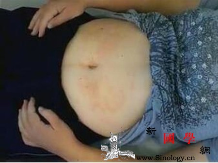 孕妇得了荨麻疹会影响孩子吗_荨麻疹-胎儿-患上-用药-