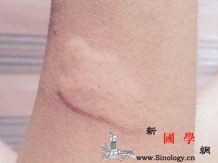孕妇荨麻疹症状及治疗方法_风疹块-组织胺-荨麻疹-病因-