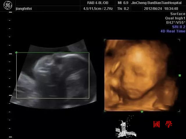 从四维彩超的这些细节可以真实看到胎儿的性别_病变-胎儿-畸形-四维-