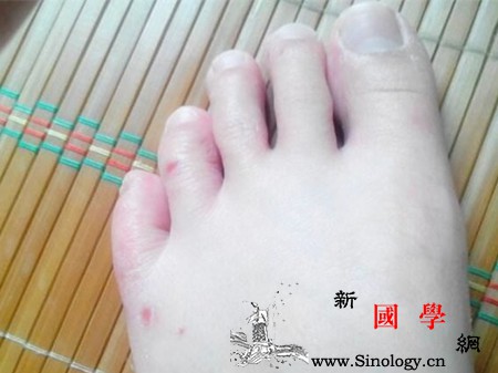 孕妇为什么会有脚气详解孕妇患脚气的原因_脚气-真菌-孕妇-感染-