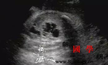 超声检出胎儿肾积水怎么办_肾盂-随访-母体-超声-